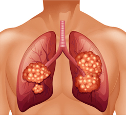 Lung cancer diagram