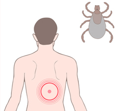 Lyme disease tick bite concept