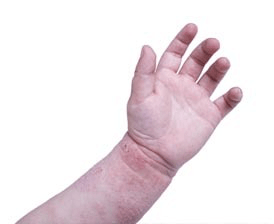 Child%e2%80%99s hand with eczema