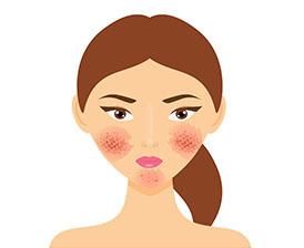 Recognizing rosacea signs