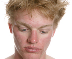 Thumbnails helprx categories acne